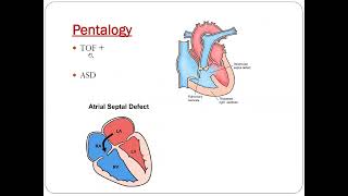 Pentalogy of fallot  Dr Akif Baig [upl. by Landre]