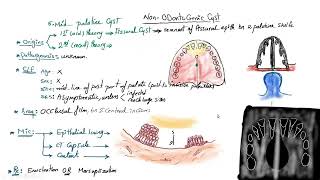 cyst revison 2 non odontogenic [upl. by Belanger560]