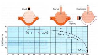 20170331 Effect of Ventilation perfusion imbalance on gas exchange [upl. by Corina]