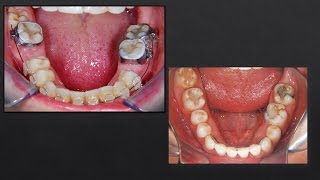 Closing Lower Spaces Orthodontics [upl. by Lrub]