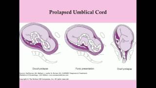 Obstetric Complications of Labor  CRASH Medical Review Series [upl. by Tomlinson698]