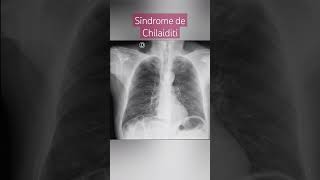 SINDROME DE CHILAIDITI SÍNTOMAS [upl. by Noitsuj]