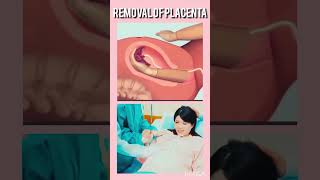 Removal of placenta fetalmovement bodypart baby cutebaby shorts [upl. by Nowyt453]