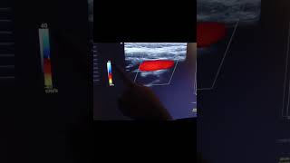 Optimizing Doppler Settings When Imaging [upl. by Eneles]