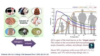 Atopic dermatitis diagnosis amp assessment Prof Ghada Shousha Pediatric immunology amp allergy Ain Shams [upl. by Virginie]