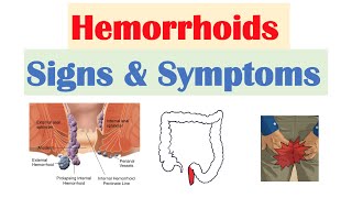 Hemorrhoids Signs amp Symptoms  Internal vs External Hemorrhoid Symptoms  Hemorrhoidal Disease [upl. by Matthei]