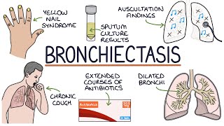 Understanding Bronchiectasis [upl. by Waldon131]