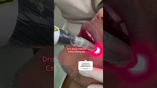 Laserterapia em doenças bucais  estomatologista laser [upl. by Noelle]