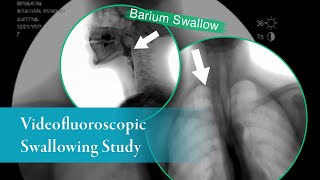 Barium Swallow Barium Esophagram AnteriorPosterior View [upl. by Finella946]