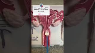 PAP Smear demonstration for Cervical cancer screening MEDICAL TIPS [upl. by Mary398]