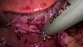 Laparoscopic Cholecystectomy 24 anam [upl. by Daggna]