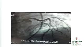 Complex PCI without OnSite Surgical Backup by Dr Azizur Rahman Roman [upl. by Kai60]