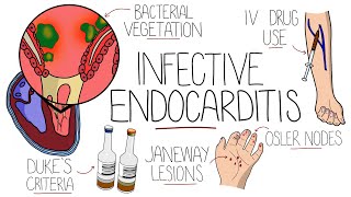 Infective Endocarditis With Duke Criteria amp Pathophysiology [upl. by Dust]