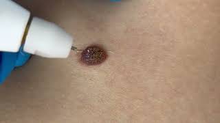 Removing Moles with Plaxel Plasma Pen Amazing Results [upl. by Eceinaj]