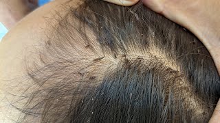 Remove many lice from brown hair  Plucking most of lice from head [upl. by Deirdre]