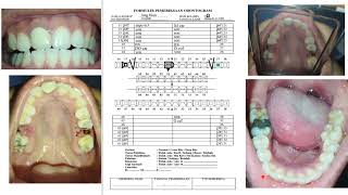 Pengisian Odontogram Kemenkes dan interpol [upl. by Ardme]