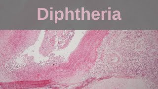 Diphtheria  Pathology mini tutorial [upl. by Delia]