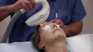 Treating facial pigmentation using an IPL Laser [upl. by Ahsinna924]