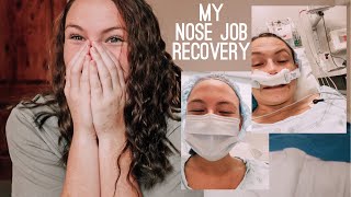 i got a nose job my recovery from septoplasty amp turbinoplasty ROUGH [upl. by Stelmach]