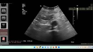 Atherosclerosis with ulcerated plaques showing triphasic waveform Check Iliac vessels Doppler case [upl. by Yanal]