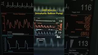 Intra Aortic Balloon Pump IABP cardiology [upl. by Yort]