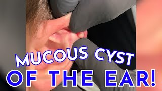 MUCOUS CYST OF THE EAR [upl. by Bianca968]