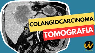 CÂNCER no FÍGADO  COLANGIOCARCINOMA Metastático [upl. by Beach181]