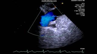 Aortic Dissection  TransEsophageal Echocardiography TEE [upl. by Bil]