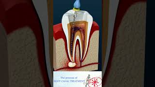 Root Canal Treatment amp Tooth Abscess [upl. by Garin]