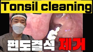 귀지형의 편도결석제거영상 Tonsil stones removal video [upl. by Naek]