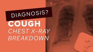 Chest XRay breakdown assessing a film with pleural plaques [upl. by Jammin177]