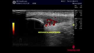 Tratamiento Tendinitis Rotuliana con EPI  Electrólisis Percutánea Intratisular [upl. by Ormand386]