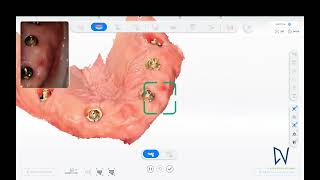 Intraoral photogrammetry double full arch scan with Shining Elite [upl. by Yecam]