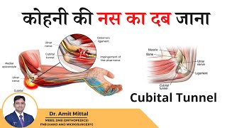 कोहनी की नस का दब जाना Ulnar nerve  Cubital Tunnel syndrome in Hindi [upl. by Imar931]