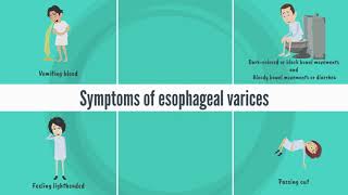 Patient education Esophageal varices The Basics [upl. by Edieh]