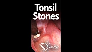 Tonsil stones forming in a large tonsil fissure [upl. by Yran]