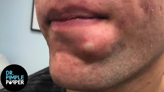 SATISFYING Dr Lee Pops Inflamed Cyst on Chin  Dr Pimple Popper Reacts [upl. by Rayham]