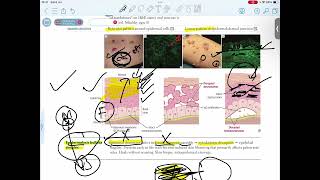 EPIDERMOLYSIS BULLOSA SIMPLEX [upl. by Eiblehs]