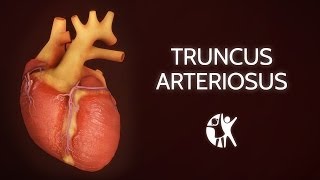 Truncus Arteriosus [upl. by Aiceila590]