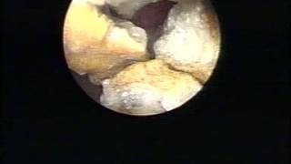 Percutaneous Nephrolithotomy PCNL Percutaneous Nephrolithotomy Surgery Video [upl. by Attenwad]