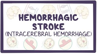 Hemorrhagic stroke intracerebral hemorrhage  causes symptoms diagnosis treatment pathology [upl. by Heda]