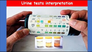 Lecture 72 Urine Analysis Tests  Interpretation [upl. by Llenreb]