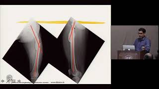 Unbelievable Transformation How We Corrected a Femur Malunion [upl. by Acilegna]