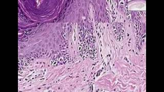 Histopathology SkinMelanoma in situ [upl. by Burbank591]