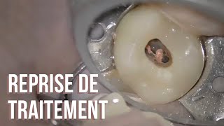 Tuto endo  Reprise de traitement d’une dent obturée au Thermafil [upl. by Raynata]