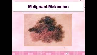 Malignant Melanoma1 [upl. by Lajet326]