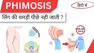 Phimosis causes symptoms and treatment in hindi [upl. by Kcirrag]