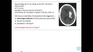 31  les anticoagulants oraux partie 4 [upl. by Esirtal]