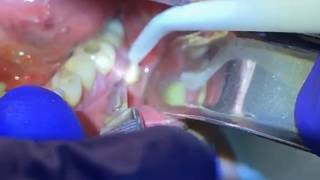 Draining a Dental Abscess  Advanced Dental Care [upl. by Kreg210]