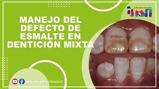 Manejo del Defecto de Esmalte en Denticiòn Mixta [upl. by Adierf]